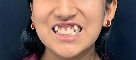 Antes del tratamiento